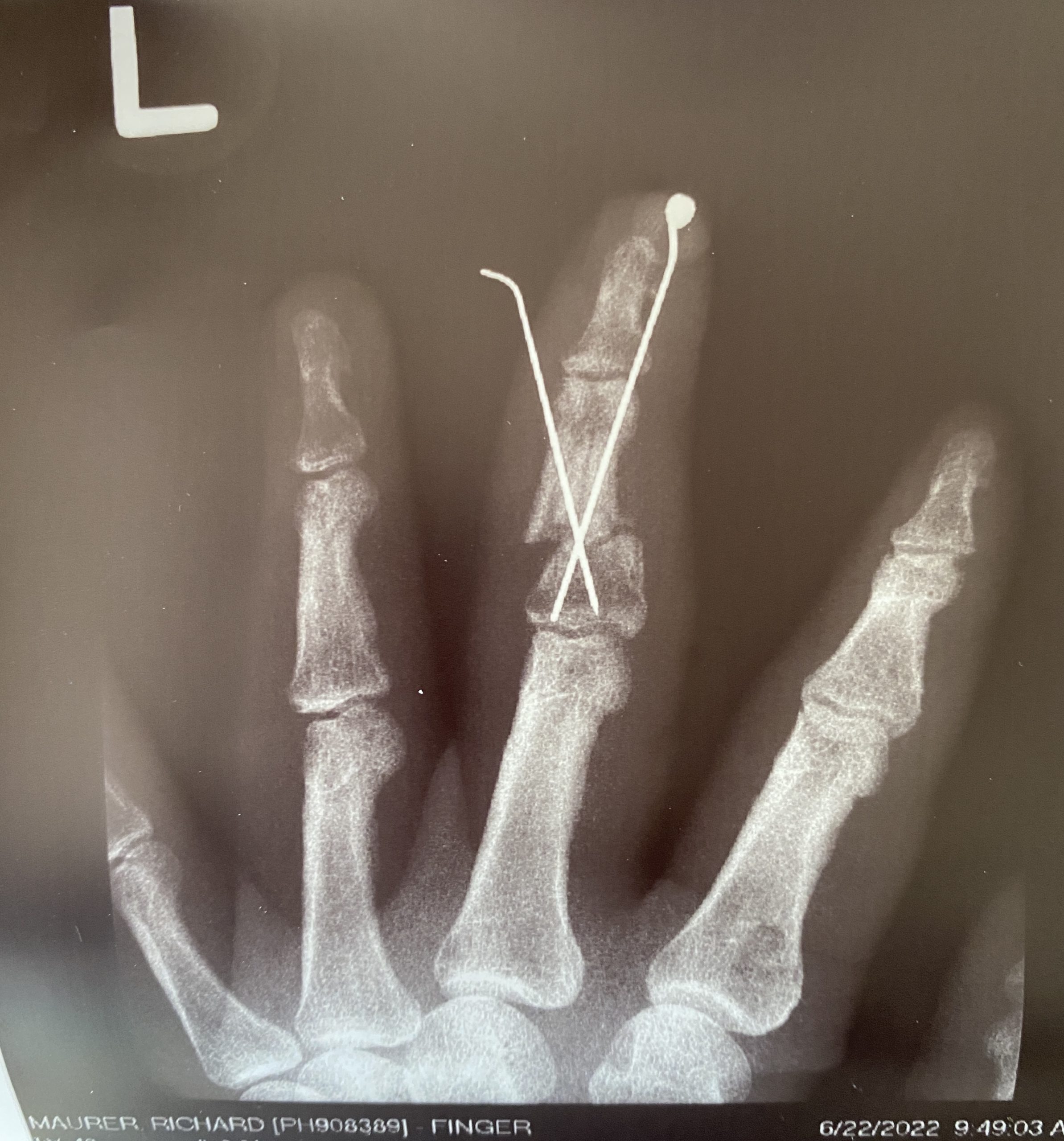 xray of broken finger
